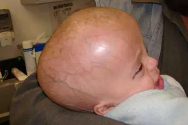 hydrocephalus after treatment