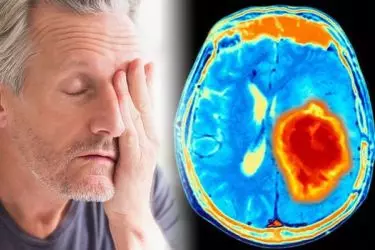 Brain Aneurysm Treatment