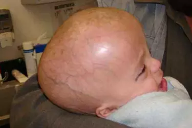 Hydrocephalus Treatment