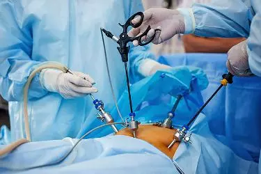 Treatment for Gall Bladder Stones