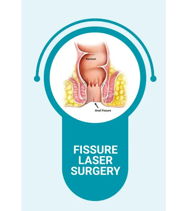 Laser fissure surgery showing minimally invasive treatment for anal fissure with precision laser care