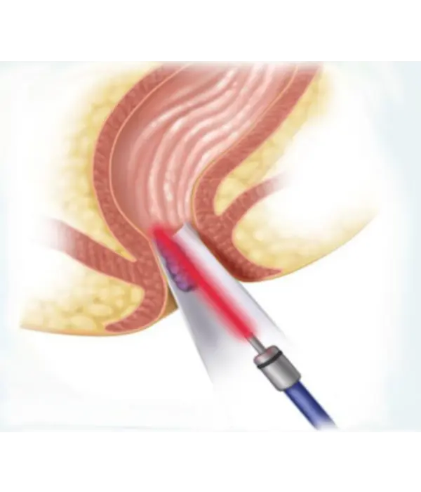 Laser piles surgery showing hemorrhoids treatment with minimally invasive laser procedure