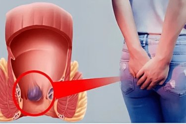 LAser Piles Surgery treatment